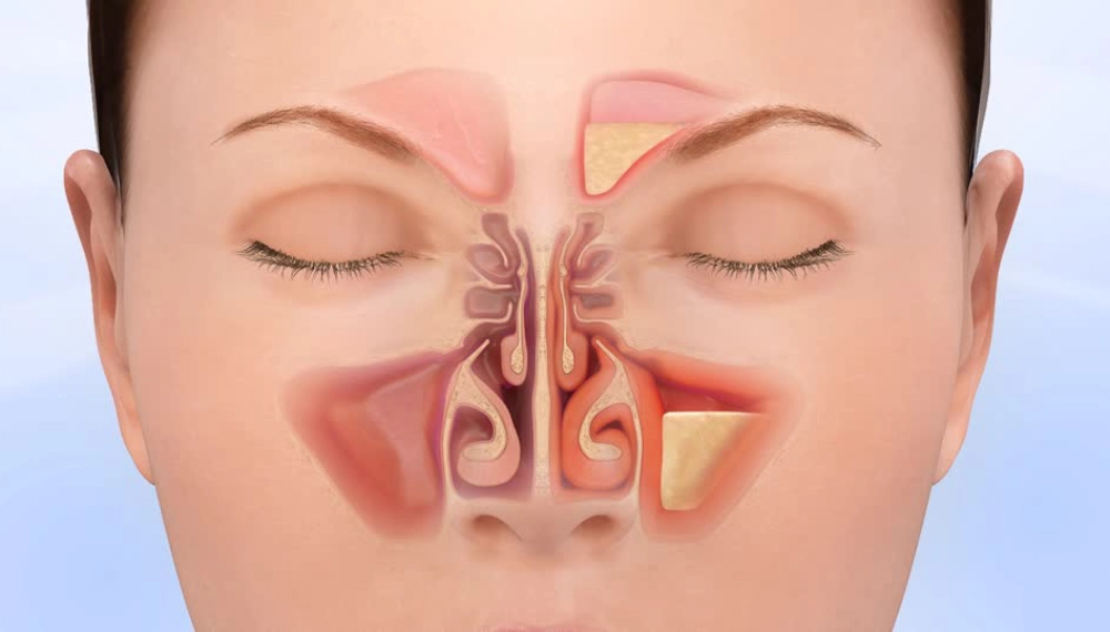 تاثیر ورزشهای فضای باز بر سینوزیت